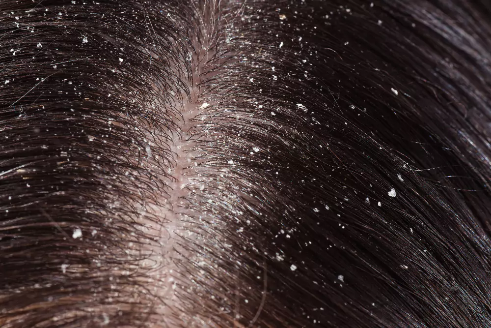 Dandruff Treatment